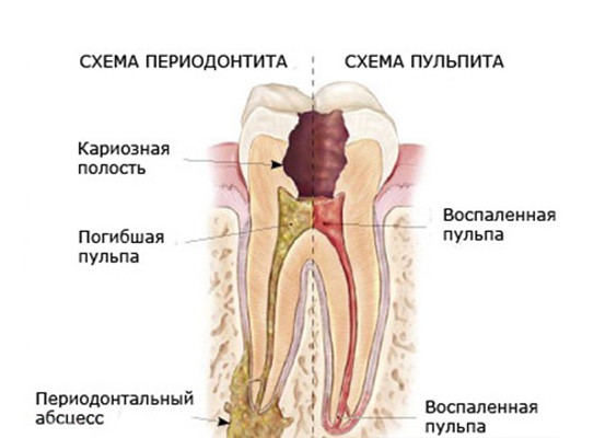 1259869_pulsiruyushchaya_bol_v_zube_pod_plomboy (553x400, 104Kb)