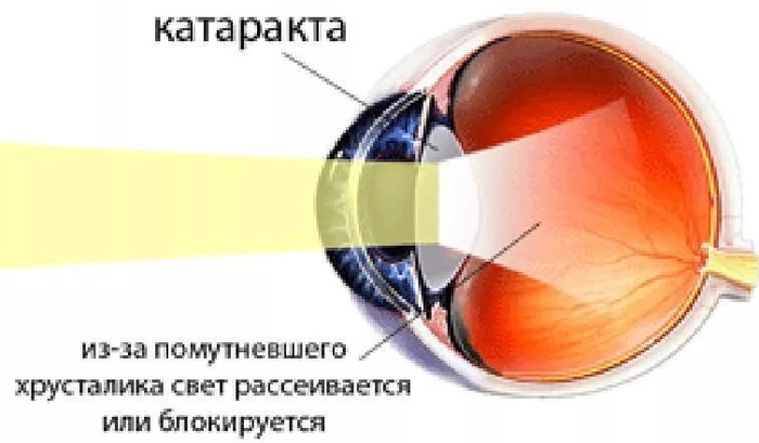 Катаракта схема. Острота зрения при катаракте. Замена хрусталика глаза при катаракте. Хрусталик при катаракте щелевая лампа.