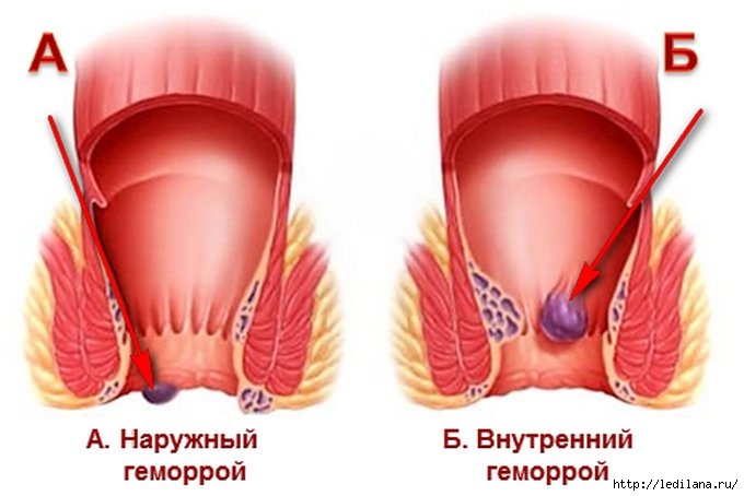 3925311_gemoroi (680x454, 126Kb)