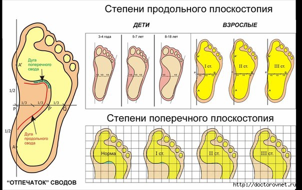 5239983_ploskostopie (604x381, 153Kb)