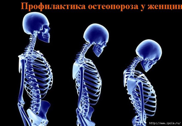 2835299_Profilaktika_osteoporoza_y_jenshin (700x482, 173Kb)