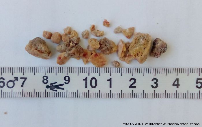 Камни в почках фото и описание перкутанная нефролитотомия Записи с меткой перкутанная нефролитотомия Дневник An