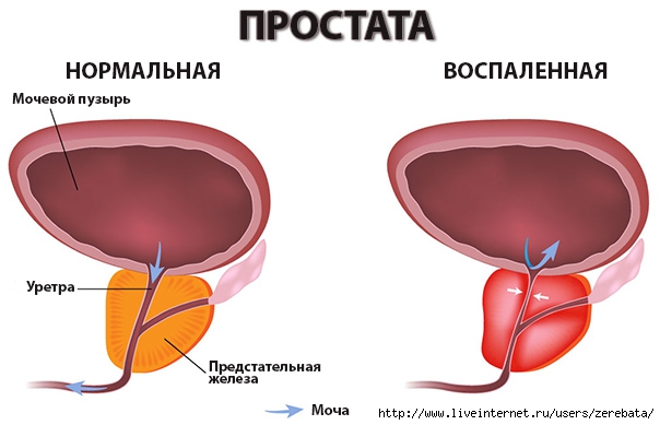 нормальная и воспаленная простата (604x389, 96Kb)