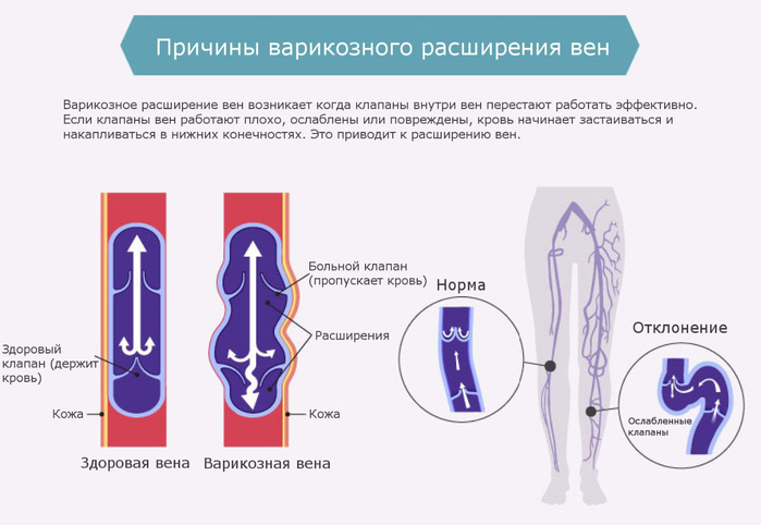 33073332-detraleks-shema-priema-pri-varikoze (700x482, 180Kb)