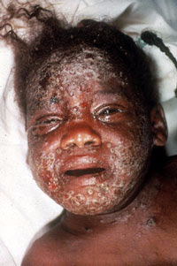 Eczema-Vaccinatum-Face-John-M-Leedom (200x301, 58Kb)