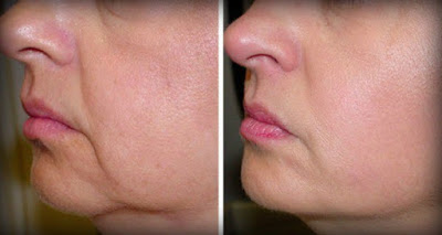 no-wrinkles-sagging-skin-face-2-ingredients (400x213, 18Kb)