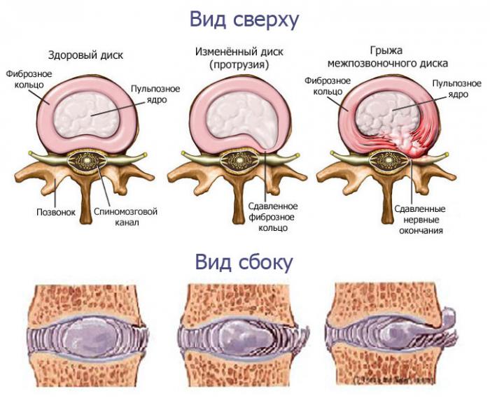 5864031_simptomi_protruzii_pozvonochnika_poyasnichnogo_otdela (700x579, 59Kb)