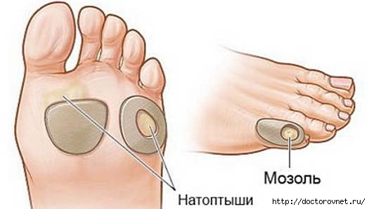 5239983_Kak_prosto_izbavitsya_ot_natoptishei_v_domashnih_ysloviyah (525x298, 62Kb)