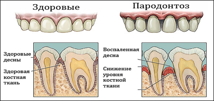 parodontozdesenkaklechatlechenievdomashn_356C0719 (700x331, 205Kb)