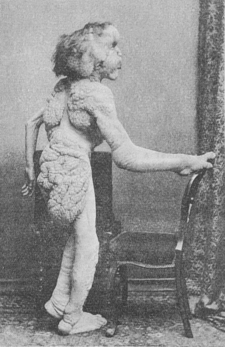 Joseph_Merrick   1889  (453x700, 223Kb)