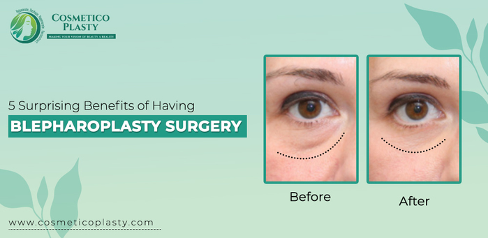 5 Surprising Benefits of having Blepharoplasty Surgery (700x341, 113Kb)