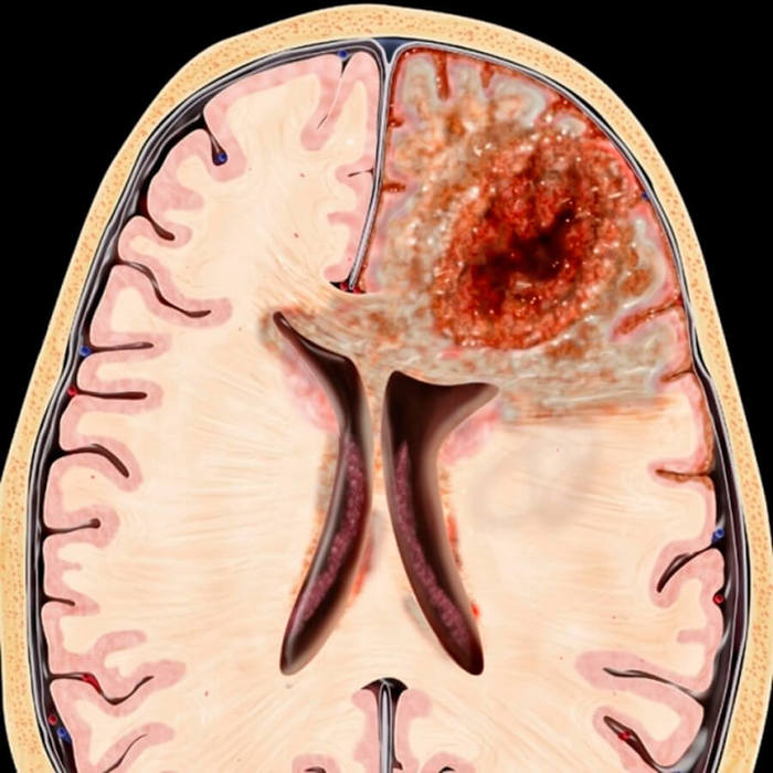 glioblastoma01 (700x700, 72Kb)