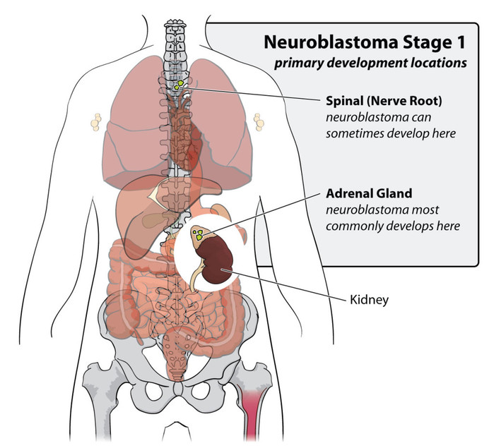 neuroblastoma-stage-1-1024x930 (700x635, 90Kb)