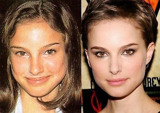 Знаменитости до и после пластической операции фото до и после